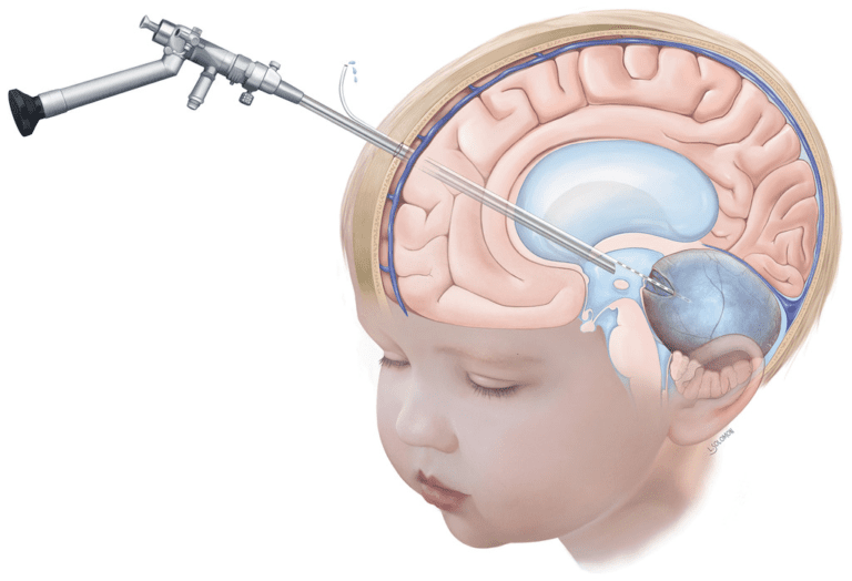 Left Frontal Cortex Function Cyst Treating Brain Cysts | Dr. Prashant Agrawal