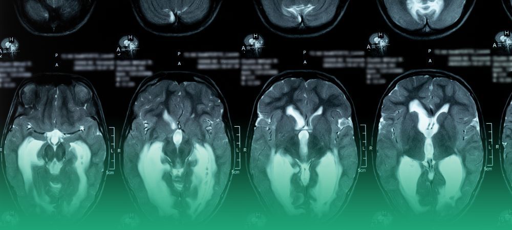 Hydrocephalus Treatment